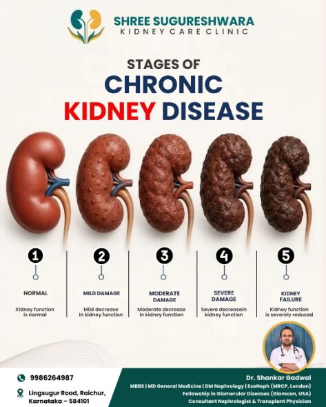 Mumbai, Health, Chronic Kidney Disease Treatment In Raichur &ndash; Expert Kidney Care