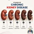 Chronic Kidney Disease Treatment In Raichur &ndash; Expert Kidney Care