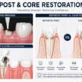 USD 59,  Cast Vs. Prefabricated Post And Core: Which To Use When