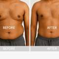 Fat Dissolving Injections In Toronto & Oakville | Injex Beauty