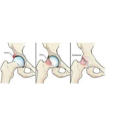 Mumbai, Health, Total Femoroacetabular Impingement Procedure| Mumbai | India| Dr Chirag Patel
