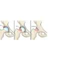 Total Femoroacetabular Impingement Procedure| Mumbai | India| Dr Chirag Patel