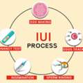 IUI Treatment In Delhi - Dr Rhythm Gupta