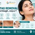 INR 1000,  Skin Tag Removal Near Rambagh Jaipur From Neck
