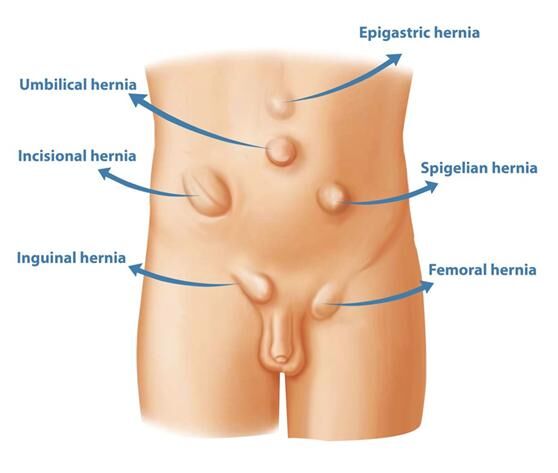 New Delhi, Health, Trusted Hernia Surgery In Delhi By Experienced Specialists