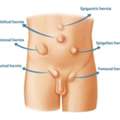 Trusted Hernia Surgery In Delhi By Experienced Specialists