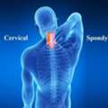 Cervical Spondylosis Physiotherapy In Gurgaon For Working Professionals