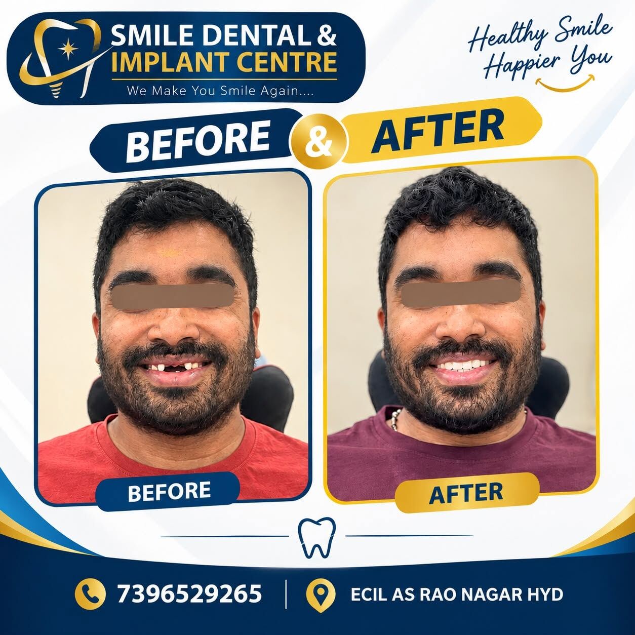 Hyderabad, Dental, See The Difference: Real Zirconia Teeth Transformation!