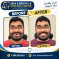 See The Difference: Real Zirconia Teeth Transformation!