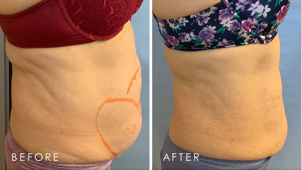 Toronto, Beautician, Fat Dissolving Stomach Before And After &ndash; Body Contouring Results
