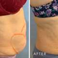 Fat Dissolving Stomach Before And After &ndash; Body Contouring Results