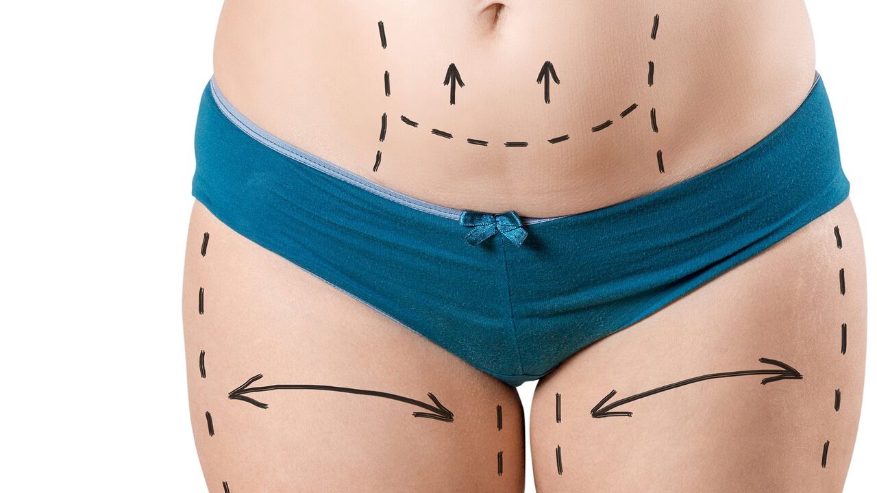 Islamabad, Health & Beauty Items, PKR 180,  Liposuction In Islamabad: What Makes Body Contouring Different From Weight Loss?