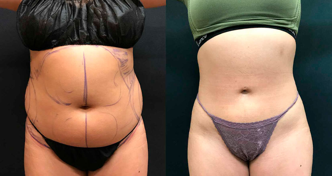 Islamabad, Health & Beauty Items, PKR 180,  Liposuction In Islamabad: What Makes Body Contouring Different From Weight Loss?