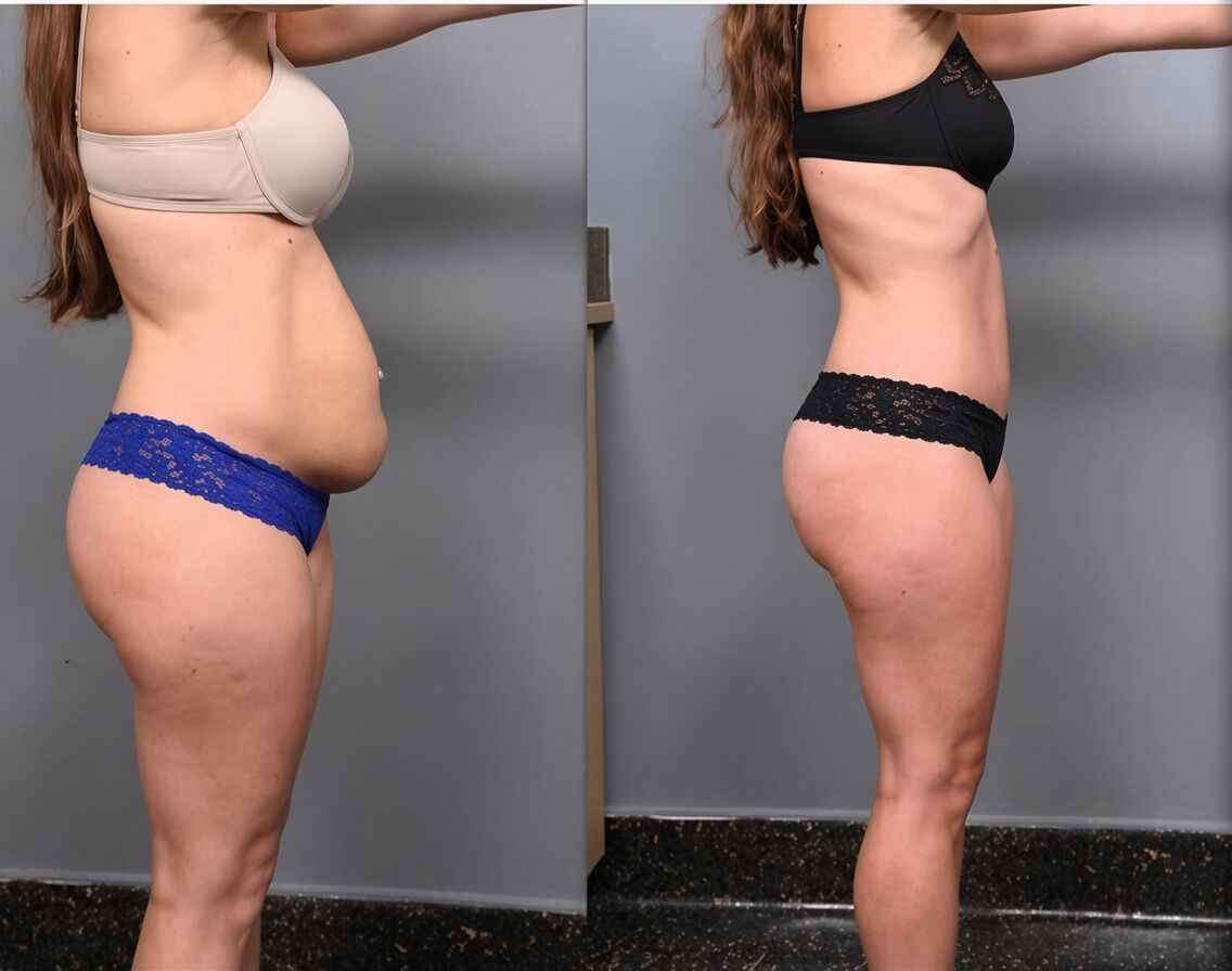 Islamabad, Health & Beauty Items, PKR 180,  Liposuction In Islamabad: What Makes Body Contouring Different From Weight Loss?