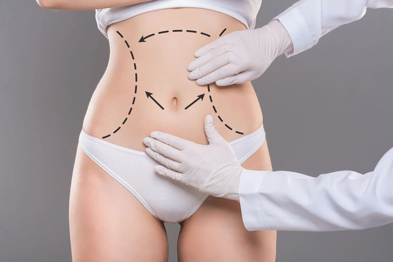Islamabad, Health & Beauty Items, PKR 180,  Liposuction In Islamabad: What Makes Body Contouring Different From Weight Loss?
