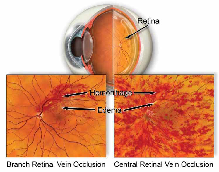 New York, Health, Professional Treatment For Retinal Circulation Problems
