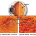 Professional Treatment For Retinal Circulation Problems