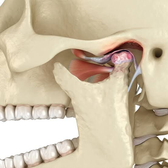 New York, Dental, Can You Get Composite Veneers With Missing Teeth?