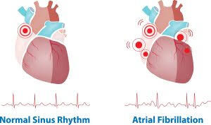 Dubai, Health, Expert Atrial Fibrillation Ablation Treatment | The Heart.ae
