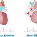 Expert Atrial Fibrillation Ablation Treatment | The Heart.ae