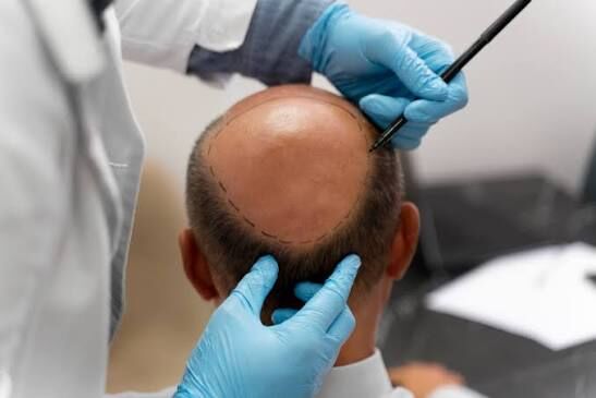 Mumbai, Health, Affordable Hair Transplant In Dehradun &mdash; Quality You Can Trust