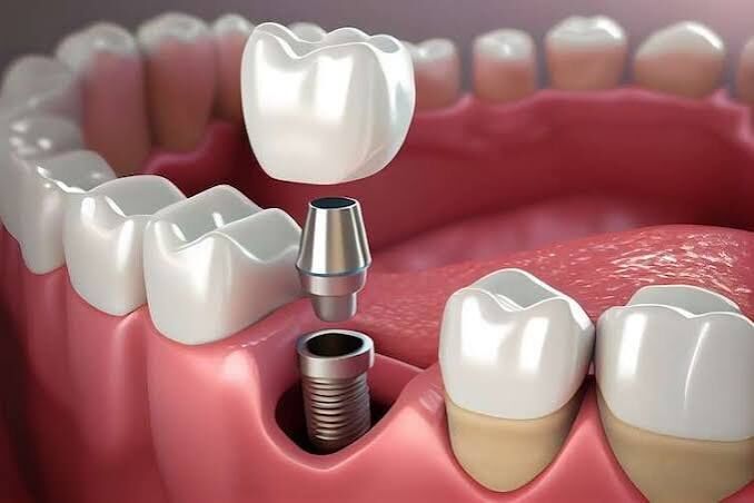 Singapore, Dental, The Breakthrough In Dentistry: Dental Implants