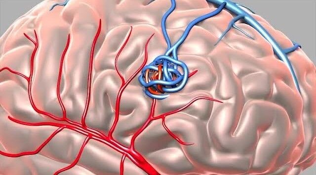 Ahmedabad, Health, Exploring Modern Aneurysm Brain Surgery Options?