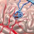 Exploring Modern Aneurysm Brain Surgery Options?