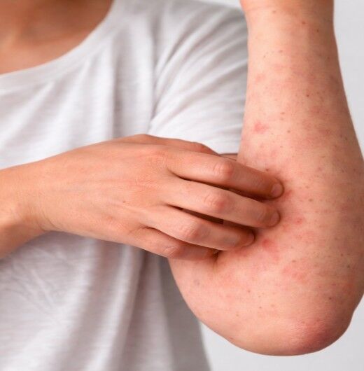 Dubai, Health, Explore Allergies Treatment In Ayurveda Dubai