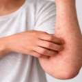 Explore Allergies Treatment In Ayurveda Dubai