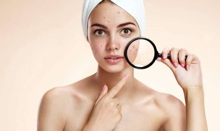 Singapore, Health, Unlocking Clear Skin: Laser Treatment For Acne Scars