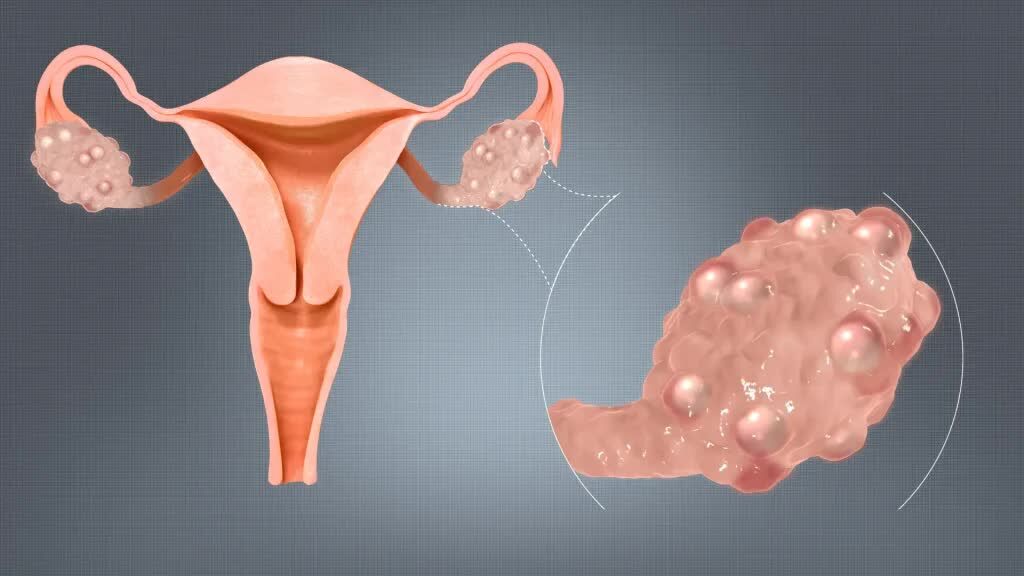 Dubai, Health, Best Pcos Doctor In Dubai &ndash; Women Health
