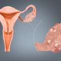 Best Pcos Doctor In Dubai &ndash; Women Health