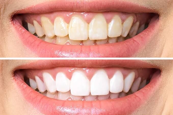 Miami, Dental, Professional Teeth Whitening & Cosmetic Dentistry In Miami