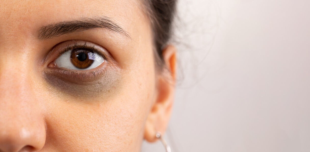 New Delhi, Health, Dark Circle Treatment In Delhi