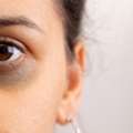 Dark Circle Treatment In Delhi