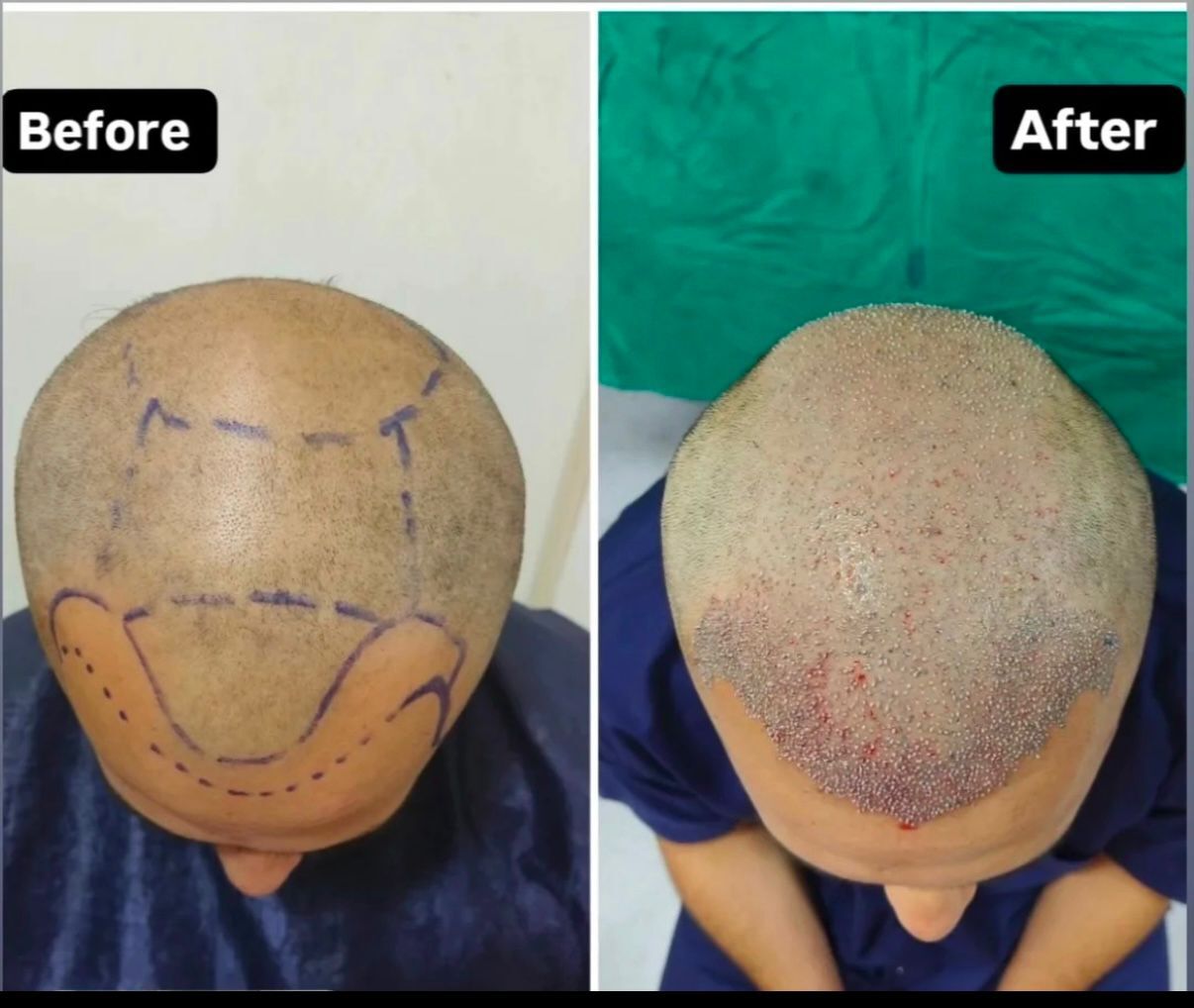 Pune, Medical, Hair Transplant In Baner - The Aesthetic Hub