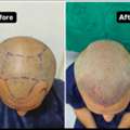 Hair Transplant In Baner - The Aesthetic Hub