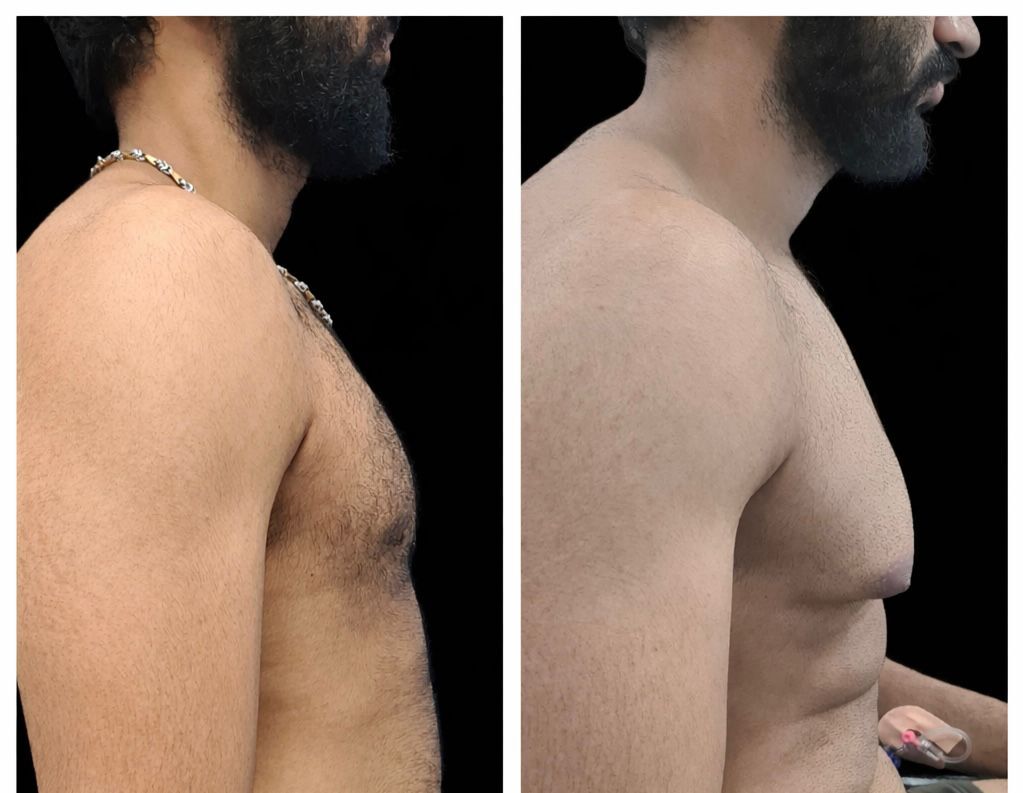 Pune, Medical, Gynecomastia Treatment In Baner - The Aesthetic Hub