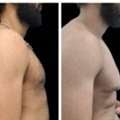 Gynecomastia Treatment In Baner - The Aesthetic Hub