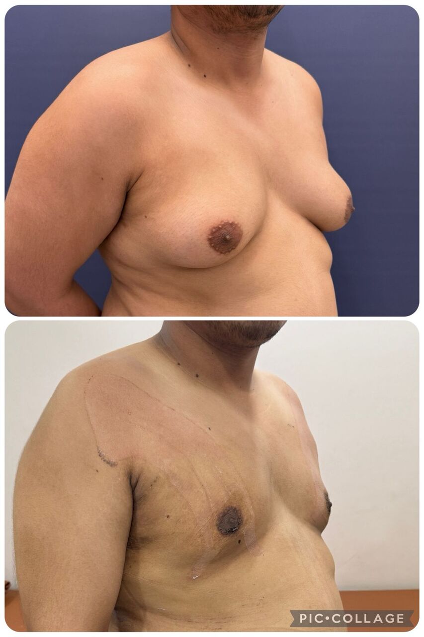 Pune, Medical, Gynecomastia Surgery In Baner  - The Aesthetic Hub