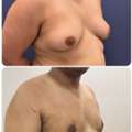Gynecomastia Surgery In Baner - The Aesthetic Hub
