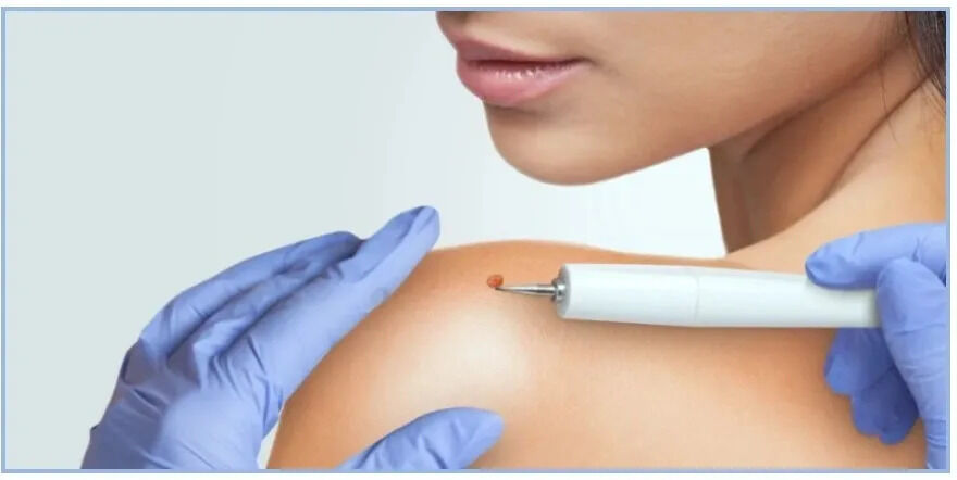 New York, Health, Trusted Dermatology Care For Mole Removal And Evaluation