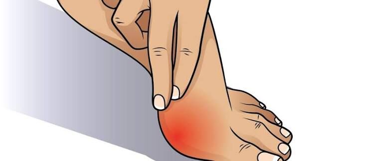 Singapore, Health, Bunion Treatment: Unmasking Effective Bunion Cures