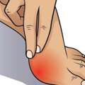 Bunion Treatment: Unmasking Effective Bunion Cures