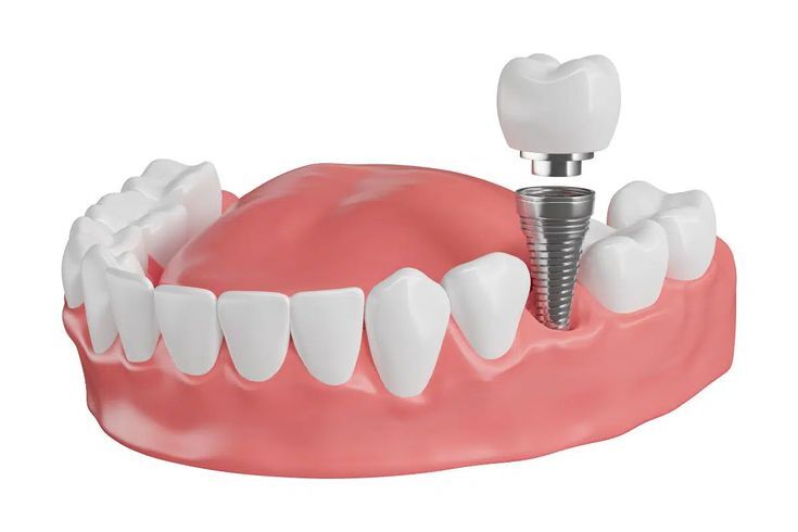 Pune, Dental, Full Mouth Rehabilitation In Pune By Dr. Hileri Mori For Advanced Dental Treatment