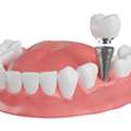 Full Mouth Rehabilitation In Pune By Dr. Hileri Mori For Advanced Dental Treatment