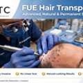 How Can You Estimate Your FUE Hair Transplant Cost?