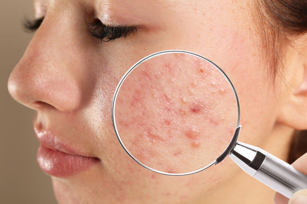 Indore, Health, Picked A Pimple And Now Have A Dark Mark?