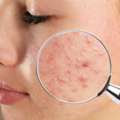 Picked A Pimple And Now Have A Dark Mark?